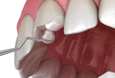 Tooth Colored Filling