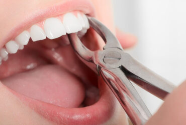 Tooth Extraction